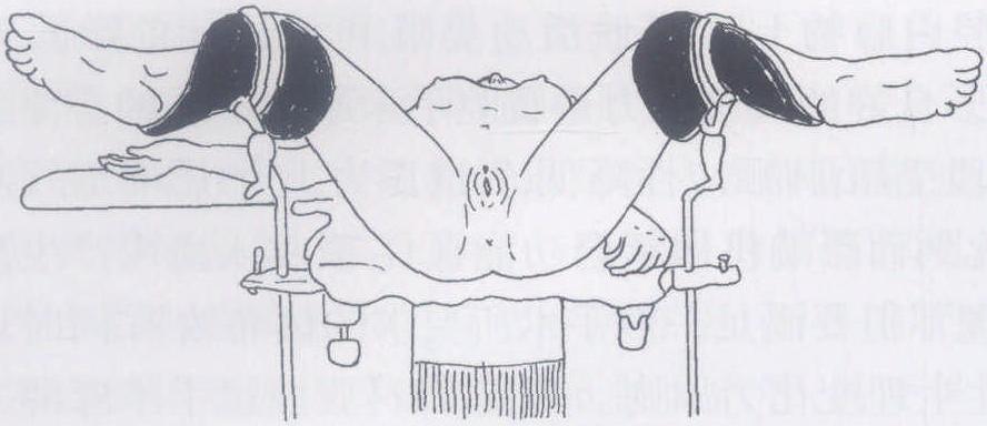 三、宫腹腔镜联合手术